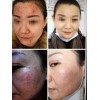 宏偉皮膚保健_專業皮膚病治療修復機構，青州面部紅血絲修復